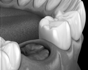 2026.Jan28①親知らず、抜いてもらいました(-_-;)